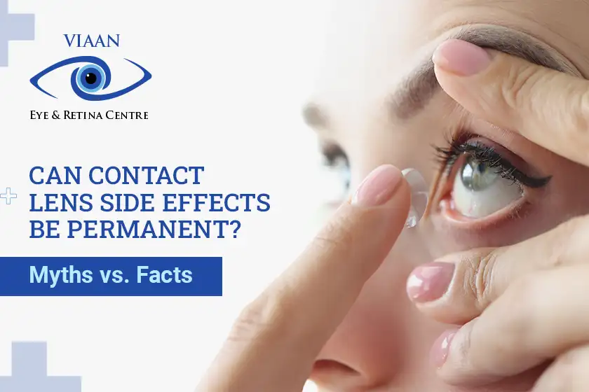 Can Contact Lens Side Effects Be Permanent? Myths vs. Facts