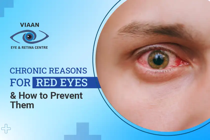 Chronic Reasons for Red Eyes and How to Prevent Them